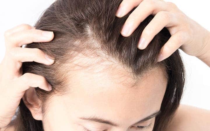 Keratin make hair falls out a lot and can lead to baldness that is difficult to treat