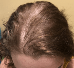 Hair Loss and Thinning