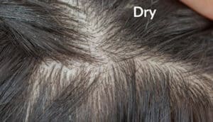 A dry scalp