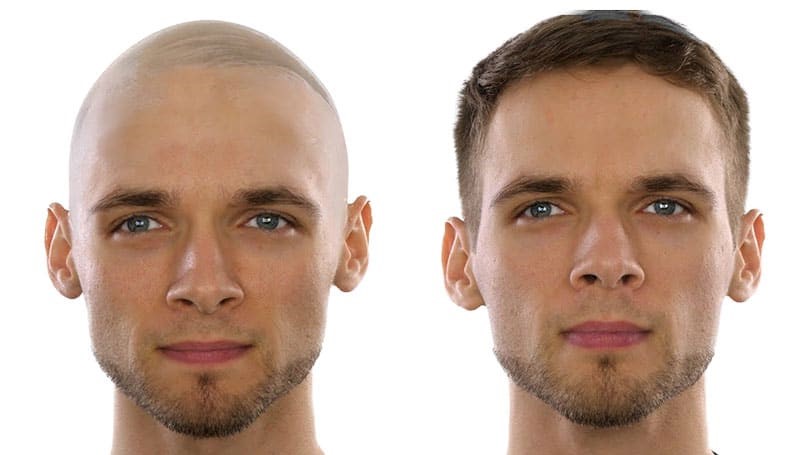 Wigs offer a quick fix for bald patches
